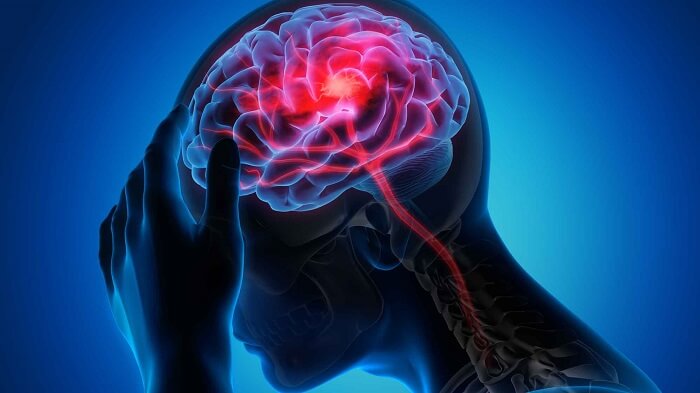 Epilepsie: Simptome, cauze, tratament si prevenire